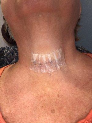 Post op parathyroid removal.