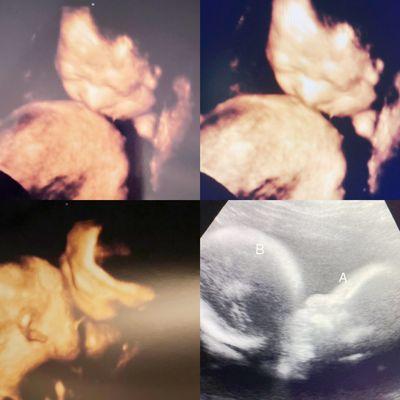 3D ultrasound picture 
BABY A KISS IS BABY B ON THE FOREHEAD