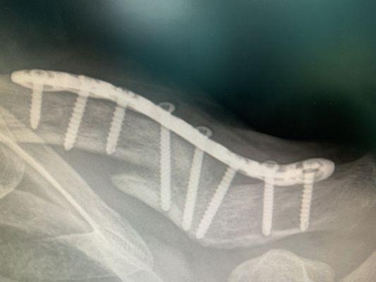 My prior collarbone injury had healed without surgery, but Mr. Moore broke the collarbone into 3 which required surgery.