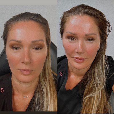 Before and after cheek, chin, lip and under-eye filler