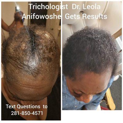 We specialize in female hair loss solutions. Our program simply gets amazing results.