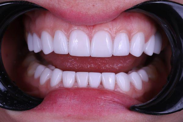 Full Mouth Porcelain Veneers / Full Mouth Rehabilitation