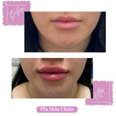 Lip Filler