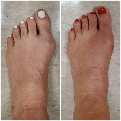 Before and after Bunion Correction minimal incision