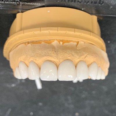 upper full mouth veneer