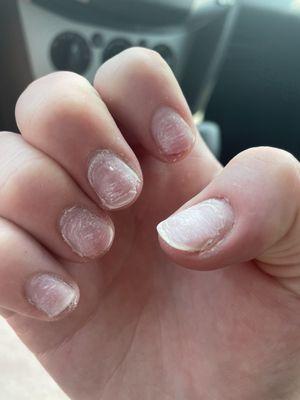 Index finger nail partially peeled off