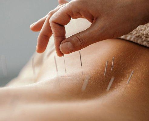 Licensed acupuncturists with extensive training in traditional Chinese medicine, committed to providing exceptional care.