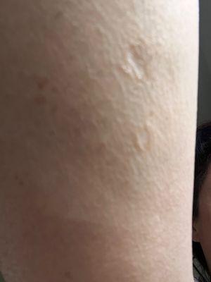 Multiple scars: all of them are atrophic, pigmented and heavily textured. These scars also show crepey and loose skin.