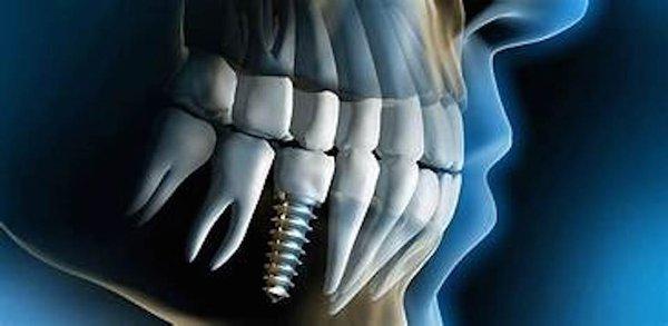 State of the Art Digital Technology and Implant Placement