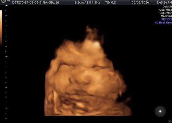 38 week squishy face