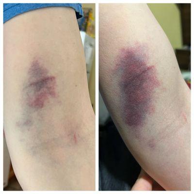 Severe bruising after being cut, poked and needle dug around in arm.