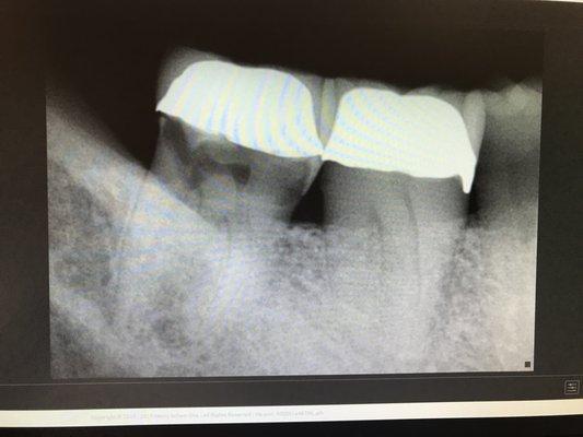 Xray of molar (on left) before extraction.