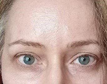 Before-normal brows