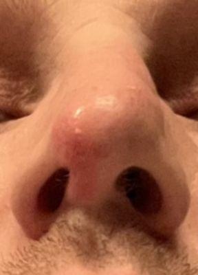 Nostrils and septum are distorted