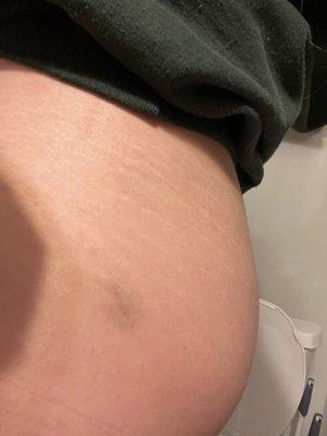 A bruise on my body from an employee who followed me out to my car and attacked me. Owner did not apologize