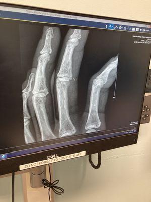 My fractured phalange!!