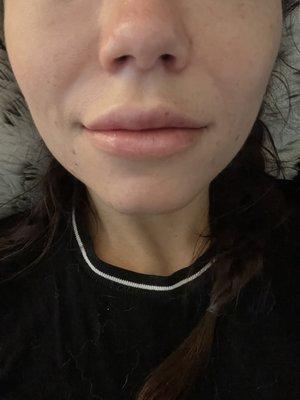 Lip filler - 1 syringe