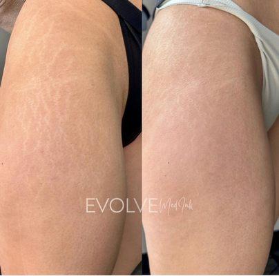 Stretch mark treatment by Elaine