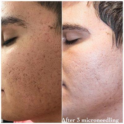 Microneedling