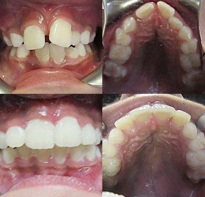 Phase 1 to make space for blocked out incisor