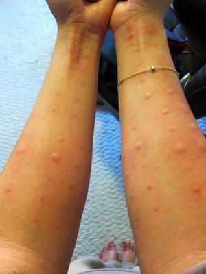 Allergy test