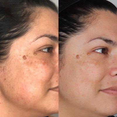 Hyperpigmentation:DMK Enzyme Series & Peel with full skincare regimen
 Total of 6 months