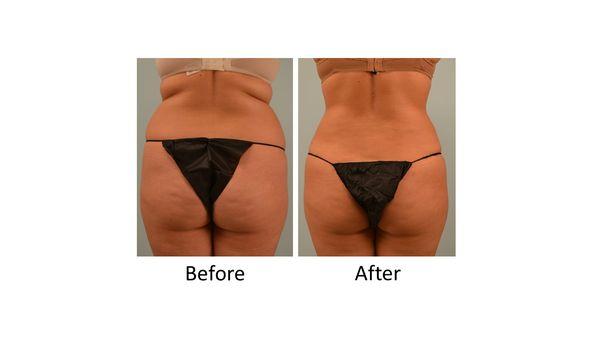 This patient received liposuction of her hip rolls and mid back.