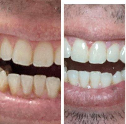 Before and After. Lightened my teeth 5 shades.