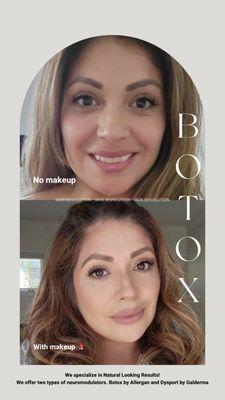 Beautiful client result 1 month after Botox with and without makeup. The goal we want to achieve is a Natural Glass Skin look!