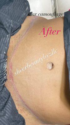 Tummy tuck scar after scar camouflage