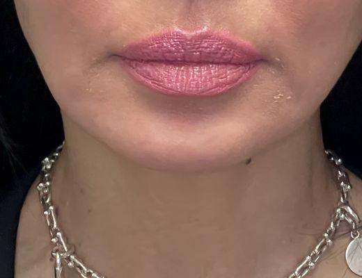 Before lips and Marionette lines treatment