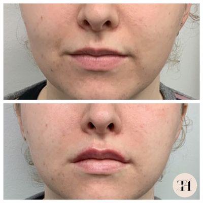 Lip filler for symmetry and balance