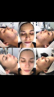 Results by esthetician Shar! Client followed instructions and was consistent and got the buy 5 get 6 Glypeel package!