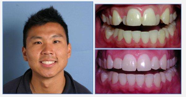 Michael - Invisalign for about a year of treatment time to correct displaced front teeth!