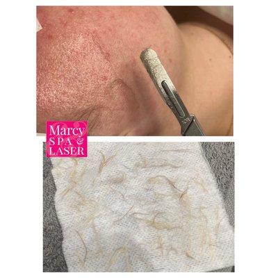 Dermaplane Facial