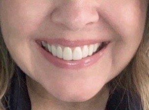 Veneers