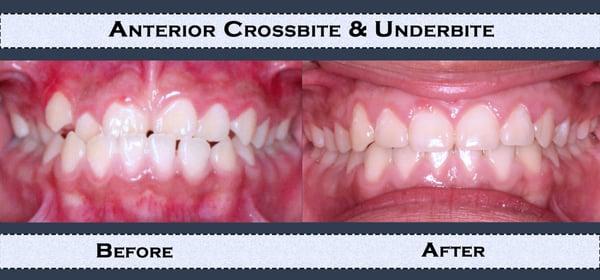 Our Work: Example of  Anterior Crossbite and Underbite