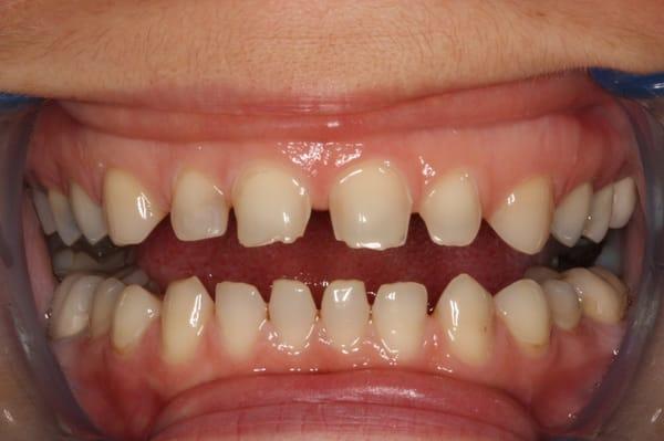 Before braces and veneers