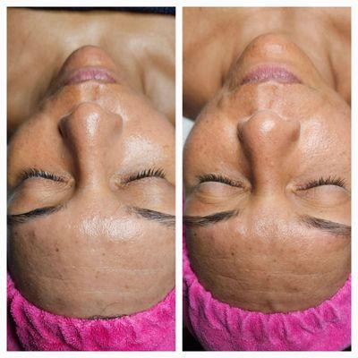 Custom Facial: Before and After