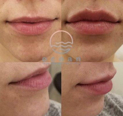 Beautiful lip enhancement.