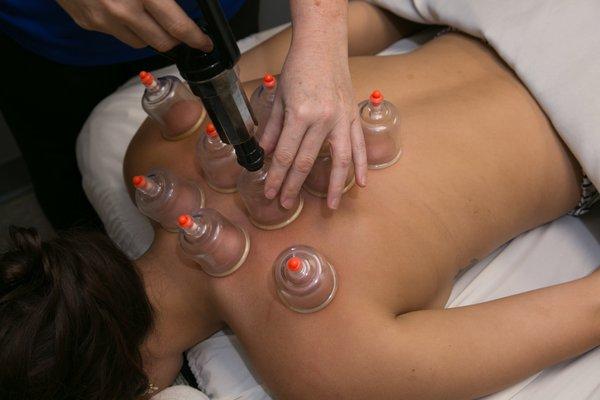 Cupping