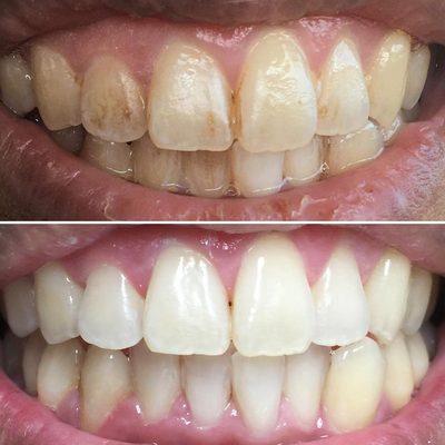 Need a whitening? See the results! Work done by Dr. Kevin Jan