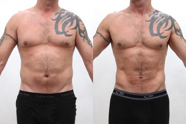 Male Aquashape Liposuction