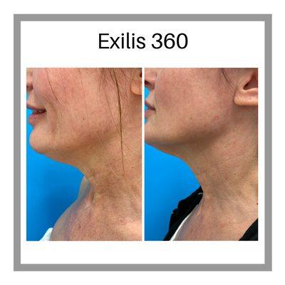 Exilis skin tightening to the under neck.