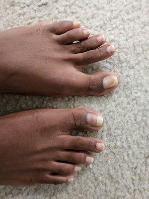 Infection in big toe and toe 2 & 3 on both feet