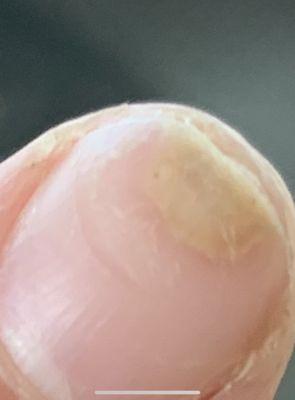 Damaged nail from acrylics