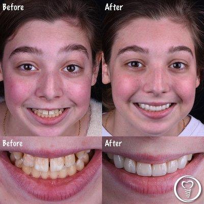 New teeth can teach you how to smile!