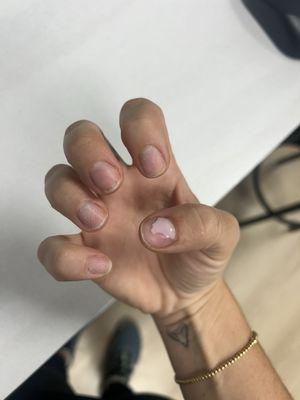 Full hand of nails gone