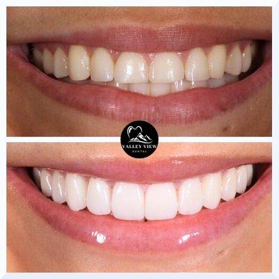 Veneers Before and After- Valley View Dental