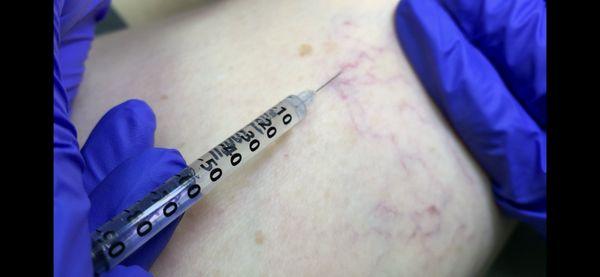 Sclerotherapy for removal of SPIDER VEINS...